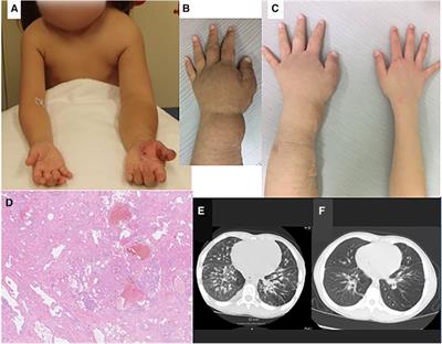 Case Report: Tuberous sclerosis complex-associated hemihypertrophy successfully treated with mTOR inhibitor sirolimus